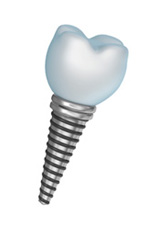 tooth implants and mini dental implants in Addison TX