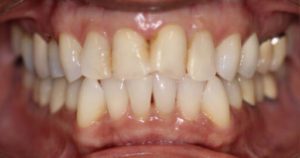 A person with receding gums, a symptom of gum disease.