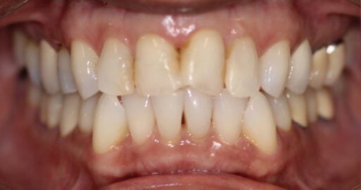 A person with receding gums, a symptom of gum disease.