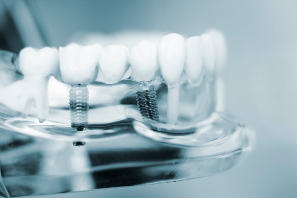 Close-up of a dental model with artificial teeth and metal implants in blue tones.