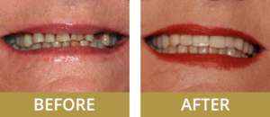 An example of a patient who has had teeth replaced with restorative dentistry.