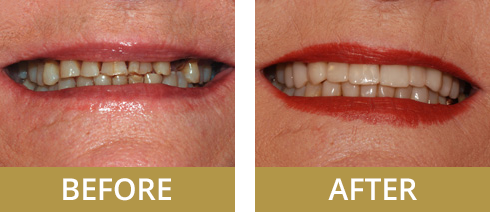 An example of a patient who has had teeth replaced with restorative dentistry.