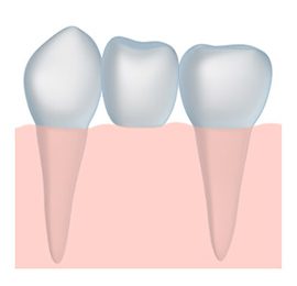 A graphic image of a dental bridge.