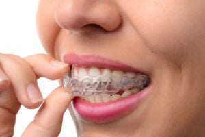 A woman inserting a clear aligner.