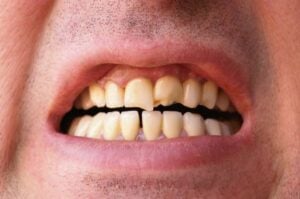 Chipped teeth that can be repaired with dental crowns in Addison.