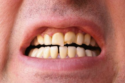 Chipped teeth that can be repaired with dental crowns in Addison.
