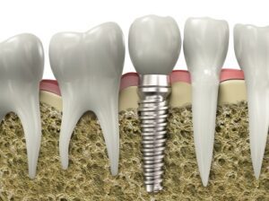A graphic image of a dental implant placed in a jawbone in Addison.