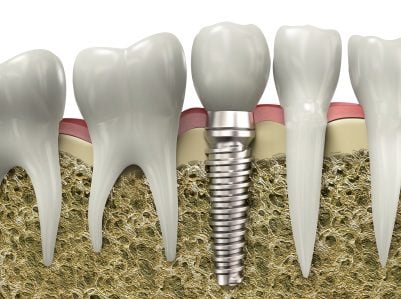 A graphic image of a dental implant placed in a jawbone in Addison.